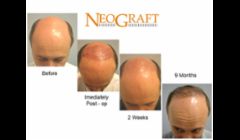 Hair Restoration