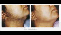Hair Removal