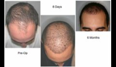 Hair Restoration