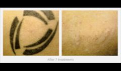 Tattoo Removal 